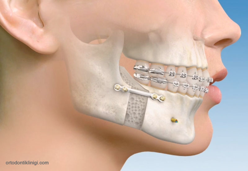 Orthognathic Surgery